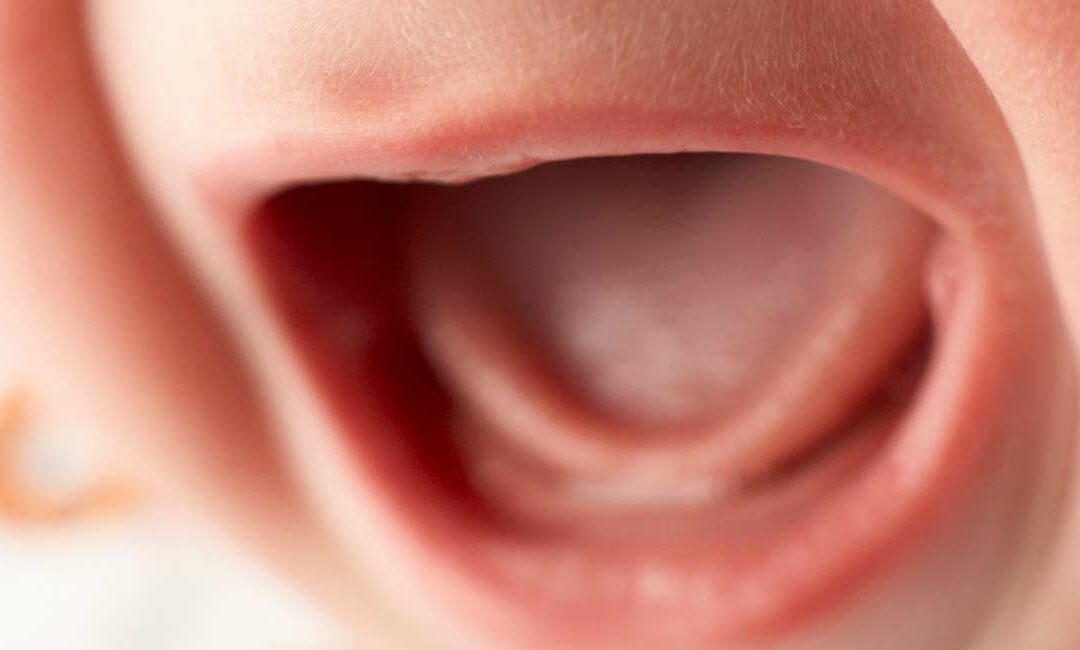 Anquiloglosia: Entendiendo su impacto en la salud bucal