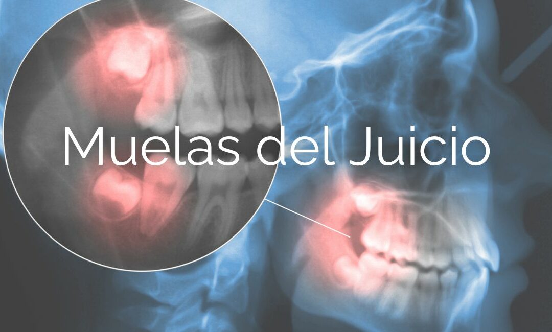 muelas del juicio