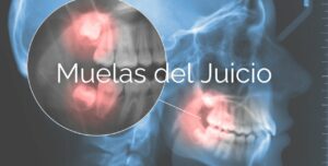 muelas del juicio
