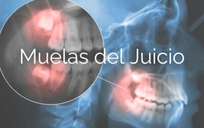 Muelas del juicio: por qué pueden afectar más de lo que imaginas