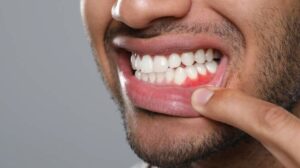 Salud encías gingivitis
